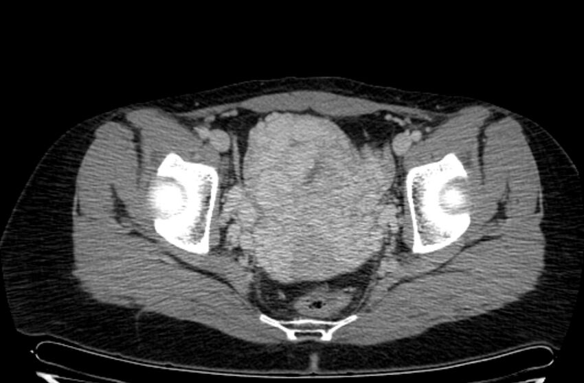 Cannonball metastases - uterine choriocarcinoma (Radiopaedia 70137-80174 A 36).jpg
