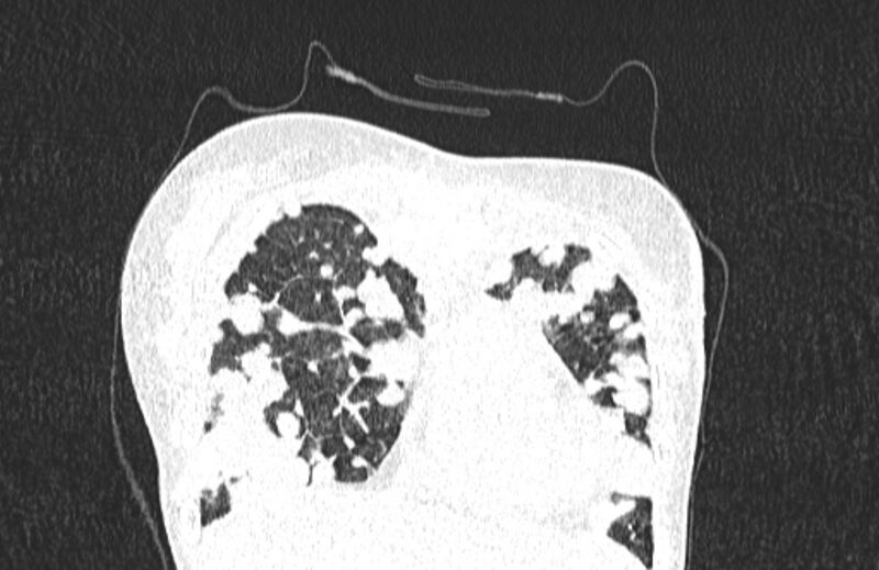 File:Cannonball metastases from breast cancer (Radiopaedia 91024-108569 Coronal lung window 24).jpg