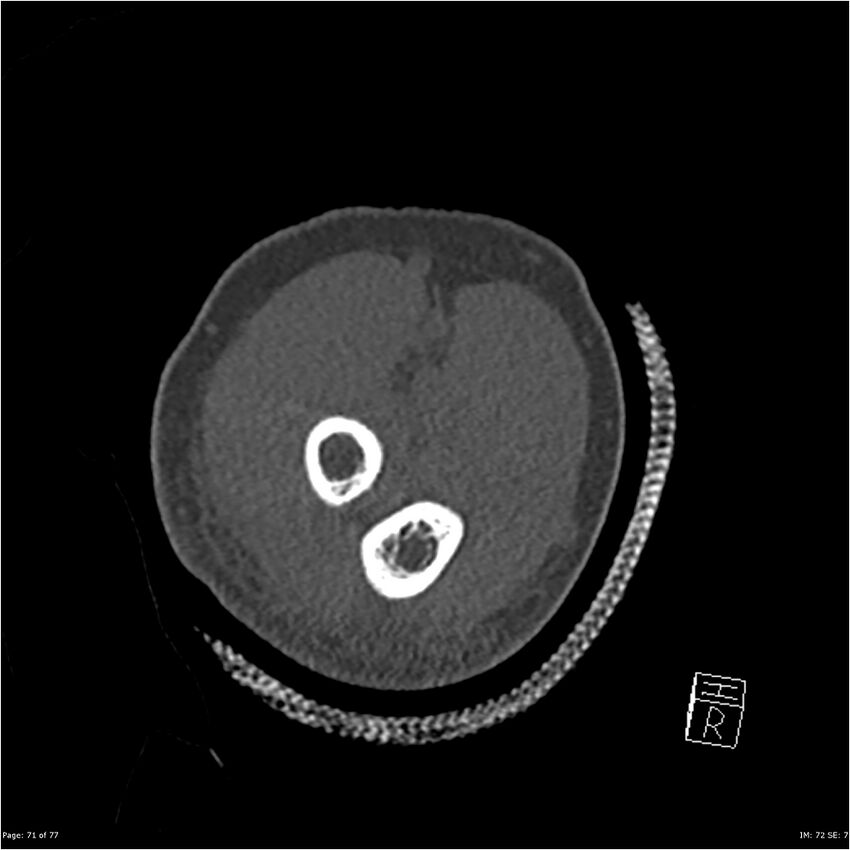 Capitellum fracture (Radiopaedia 23352-23426 Coronal bone window 71).jpg