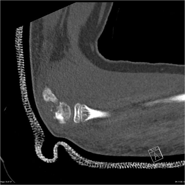 File:Capitellum fracture (Radiopaedia 23352-23426 Sagittal bone window 8).jpg
