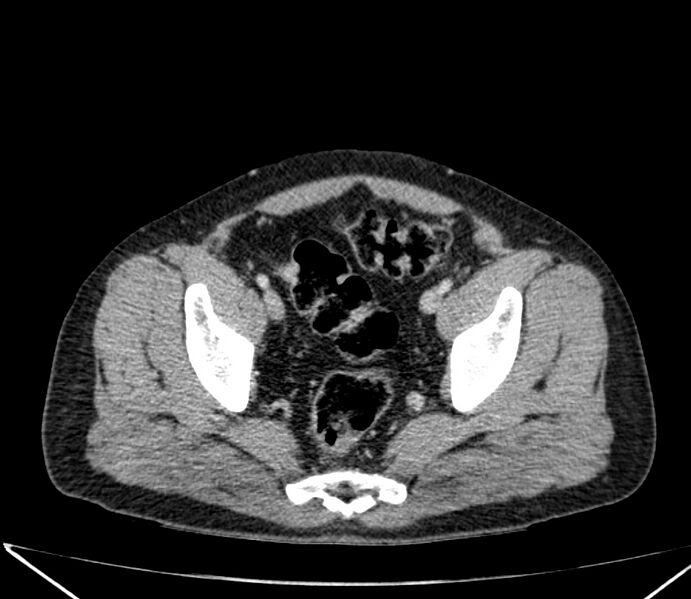 File:Carcinoid tumor with hepatic metastases (Radiopaedia 22651-22670 C 70).jpg