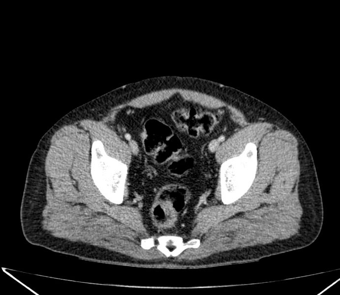 File:Carcinoid tumor with hepatic metastases (Radiopaedia 22651-22670 C 71).jpg