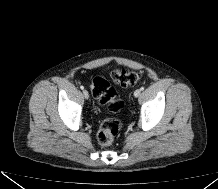 Carcinoid tumor with hepatic metastases (Radiopaedia 22651-22670 C 71).jpg