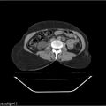 Carcinoma cervix- recurrence (Radiopaedia 34702-36137 B 80).jpg
