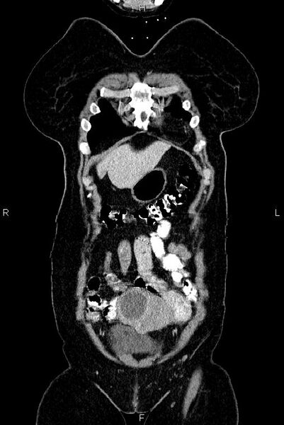 File:Carcinoma of uterine cervix (Radiopaedia 85861-101700 C 3).jpg