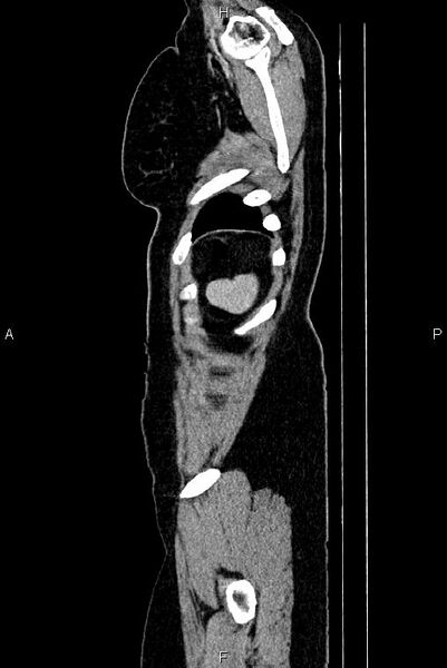 File:Carcinoma of uterine cervix (Radiopaedia 85861-101700 D 84).jpg