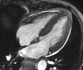 Cardiac amyloidosis (Radiopaedia 39736-42124 D 17).jpg