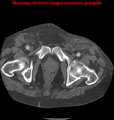 Cardiac perforation following transcatheter aortic valve implantation (Radiopaedia 23714-23863 B 10).png