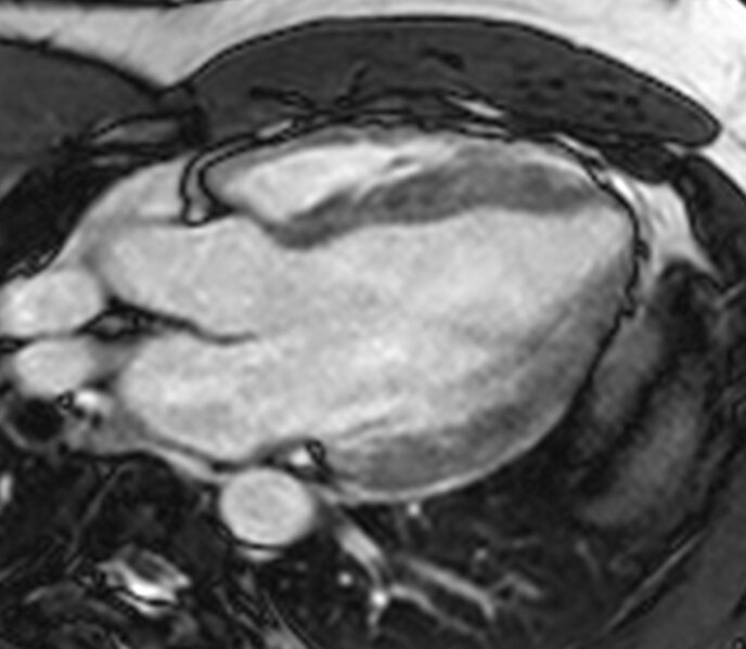 File:Cardiac sarcoidosis (Radiopaedia 39811-42243 LVOT cine images 20).jpg