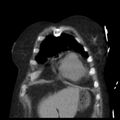 Cardiogenic pulmonary edema (Radiopaedia 29213-29609 Coronal non-contrast 5).jpg