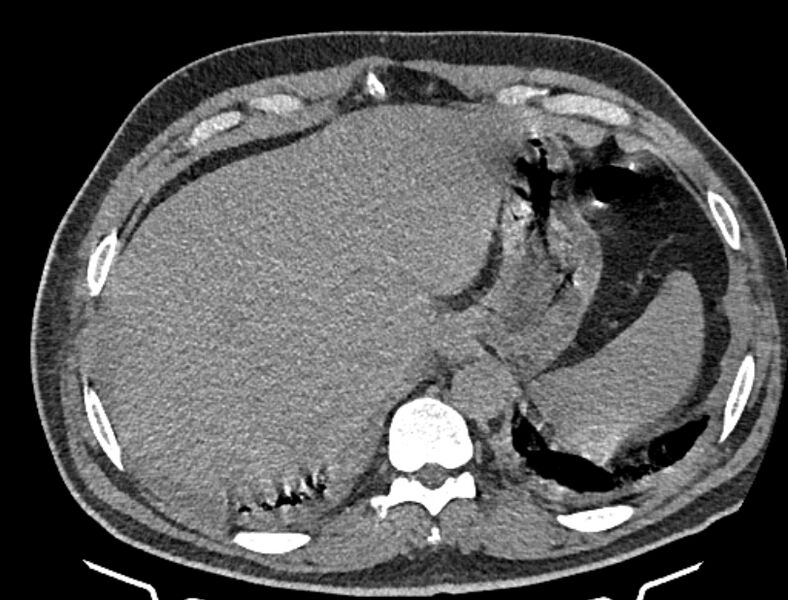 File:Cardiogenic pulmonary edema (Radiopaedia 68180-77678 Axial non-contrast 50).jpg