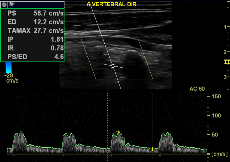 File:Carotid artery stenosis (Radiopaedia 28786-29088 G 1).png