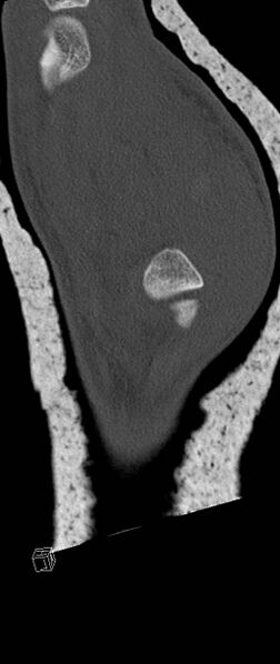 File:Carpal fractures (smart watch impaction) (Radiopaedia 55844-62430 Sagittal bone window 40).jpg