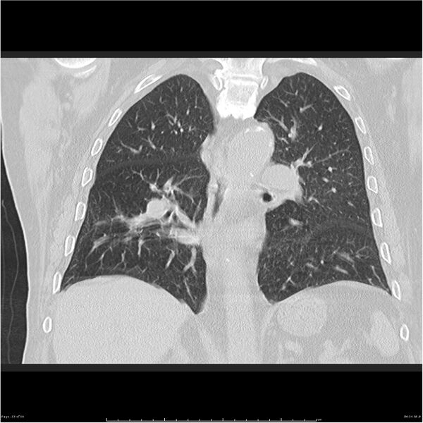 File:Cavitating left lower lobe lesion - squamous cell lung cancer (Radiopaedia 27749-28176 Coronal lung window 33).jpg