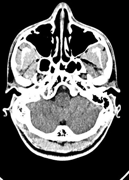 File:Cavum septum pellucidum and cavum vergae (Radiopaedia 77797-90060 Axial Brain Window 18).jpg