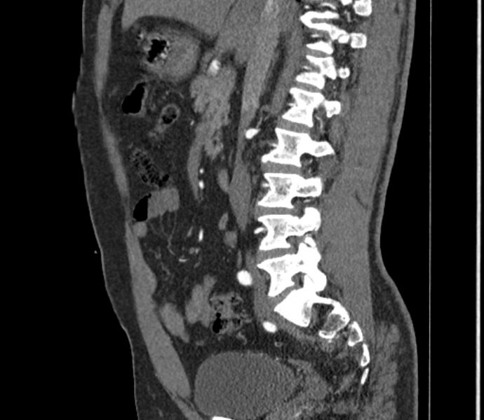 File:Celiac artery dissection (Radiopaedia 52194-58080 B 27).jpg