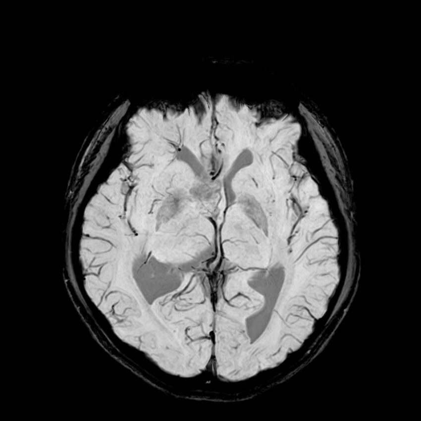 Central neurocytoma (Radiopaedia 79320-92380 Axial SWI 65).jpg