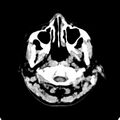 Cerebellar abscess secondary to mastoiditis (Radiopaedia 26284-26412 Axial non-contrast 3).jpg