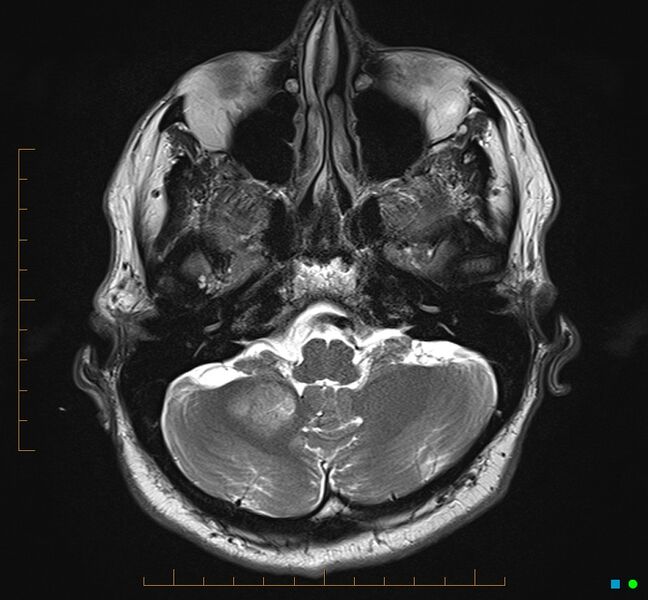 File:Cerebellar gangliocytoma (Radiopaedia 65377-74422 Axial T2 7).jpg