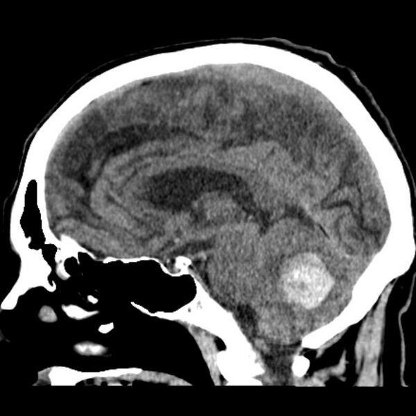 File:Cerebellar hemorrhage (Radiopaedia 27193-27359 C 24).jpg