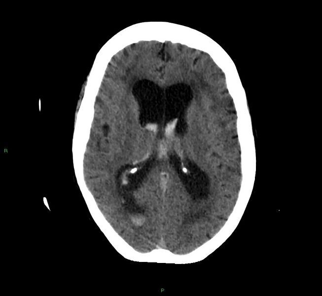 File:Cerebellar hemorrhage (Radiopaedia 58792-66026 Axial non-contrast 24).jpg
