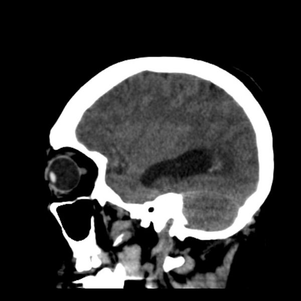 File:Cerebellar hemorrhage causing obstructive hydrocephalus (Radiopaedia 33989-35207 B 35).jpg