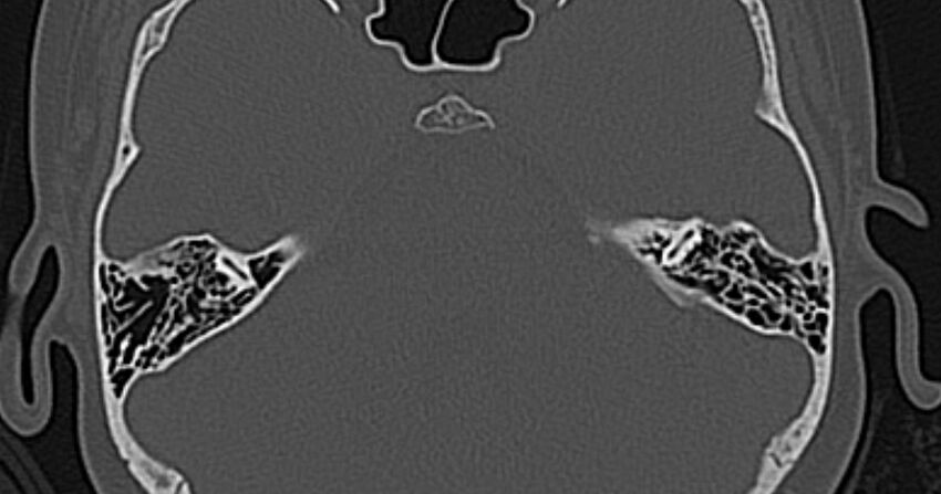 Cerebellopontine angle lipoma (Radiopaedia 57303-64242 Axial bone window 44).jpg