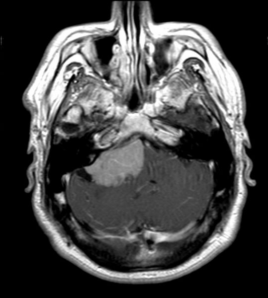 File:Cerebellopontine angle meningioma (Radiopaedia 24459-24764 Axial T1 C+ 6).jpg