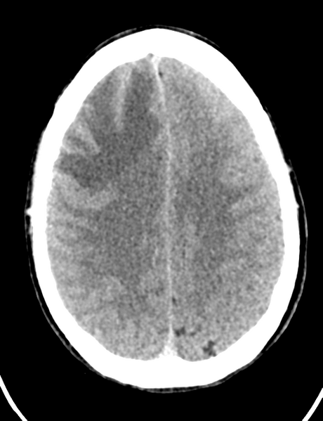 File:Cerebral abscess (Radiopaedia 60342-68008 Axial non-contrast 37).png