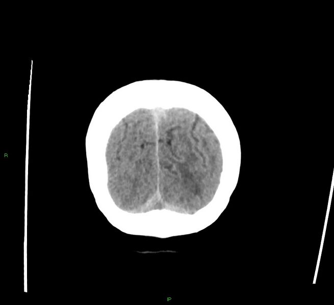 File:Cerebral amyloid angiopathy-associated lobar intracerebral hemorrhage (Radiopaedia 58378-65516 Coronal non-contrast 9).jpg