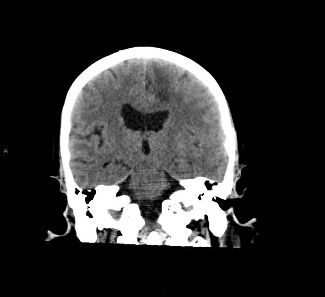 File:Cerebral amyloid angiopathy-associated lobar intracerebral hemorrhage (Radiopaedia 58529-65681 Coronal non-contrast 32).jpg