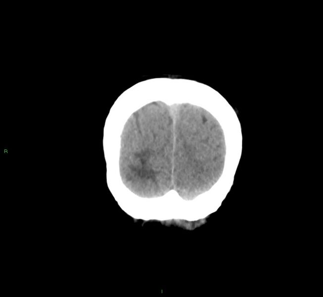 File:Cerebral amyloid angiopathy-associated lobar intracerebral hemorrhage (Radiopaedia 58561-65724 Coronal non-contrast 10).jpg