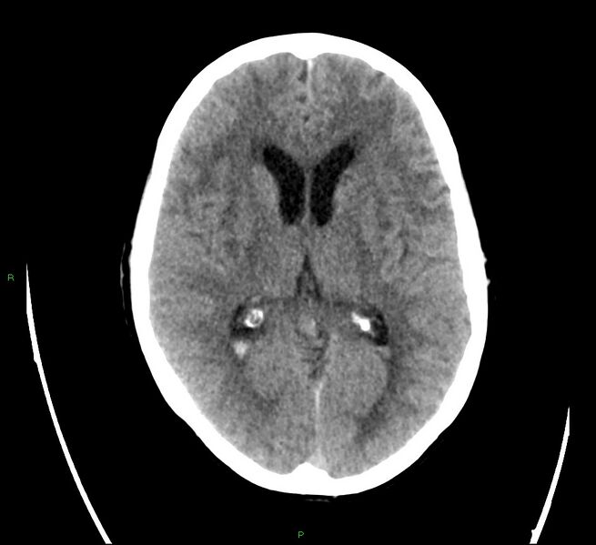 File:Cerebral amyloid angiopathy-associated lobar intracerebral hemorrhage (Radiopaedia 58566-65731 Axial non-contrast 13).jpg