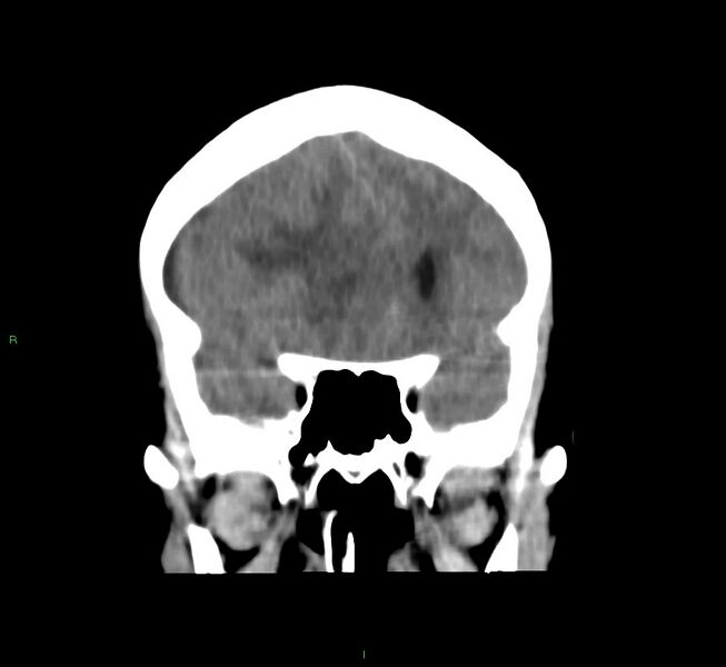File:Cerebral amyloid angiopathy-associated lobar intracerebral hemorrhage (Radiopaedia 58751-65972 Coronal non-contrast 42).jpg