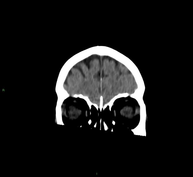 File:Cerebral amyloid angiopathy-associated lobar intracerebral hemorrhage (Radiopaedia 58757-65978 Coronal non-contrast 56).jpg