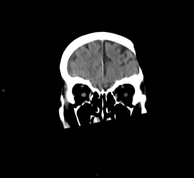 File:Cerebral amyloid angiopathy-associated lobar intracerebral hemorrhage (Radiopaedia 58758-65980 Coronal non-contrast 51).jpg