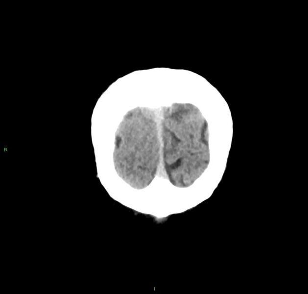 File:Cerebral amyloid angiopathy-associated lobar intracerebral hemorrhage (Radiopaedia 59356-66716 Coronal non-contrast 8).jpg