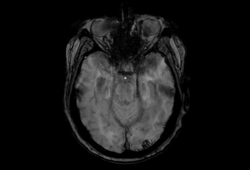 File:Cerebral amyloid angiopathy (Radiopaedia 86671-102792 Axial Gradient Echo 37).jpg