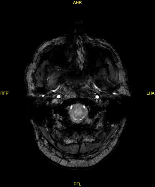 File:Cerebral autosomal dominant arteriopathy with subcortical infarcts and leukoencephalopathy (CADASIL) (Radiopaedia 86108-102054 Axial SWI 11).jpg