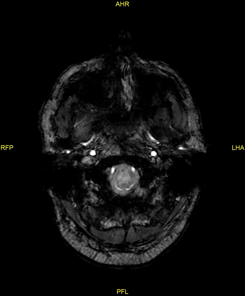 Cerebral autosomal dominant arteriopathy with subcortical infarcts and leukoencephalopathy (CADASIL) (Radiopaedia 86108-102054 Axial SWI 11).jpg