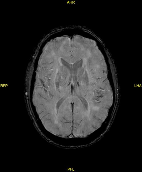 File:Cerebral autosomal dominant arteriopathy with subcortical infarcts and leukoencephalopathy (CADASIL) (Radiopaedia 86108-102054 Axial SWI 62).jpg