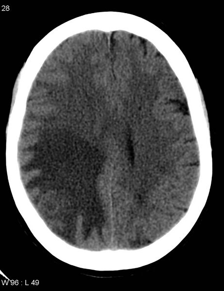 File:Cerebral metastasis - lung cancer (Radiopaedia 5315-7072 Axial non-contrast 7).jpg