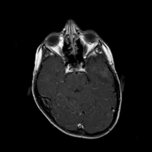 File:Cerebral tuberculoma (Radiopaedia 41152-43932 Axial T1 C+ 7).jpg