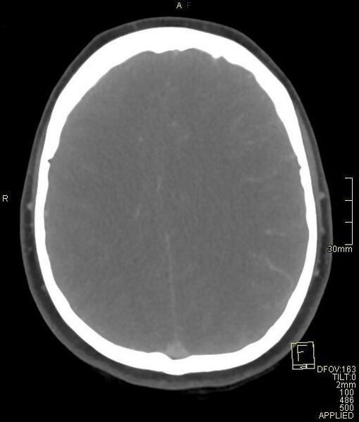 File:Cerebral venous sinus thrombosis (Radiopaedia 91329-108965 Axial venogram 56).jpg