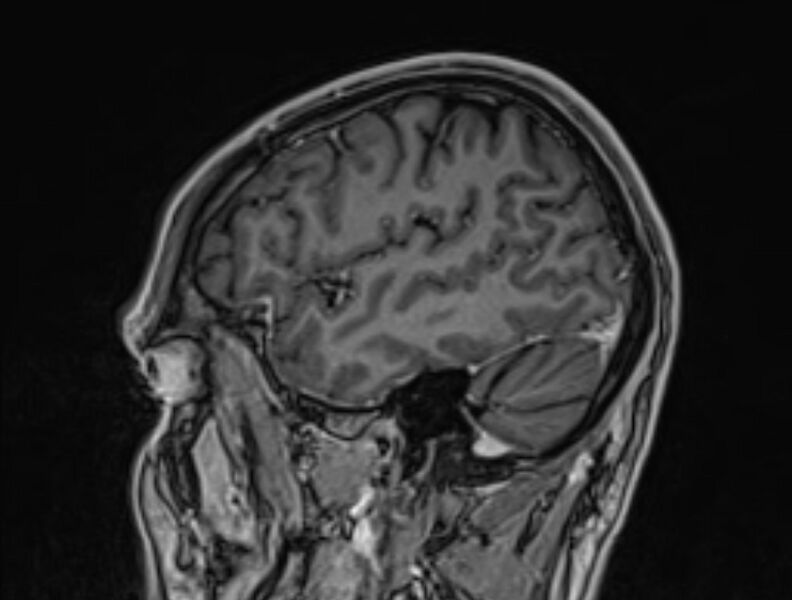 File:Cerebral venous thrombosis (Radiopaedia 71207-81504 Sagittal T1 C+ 10).jpg