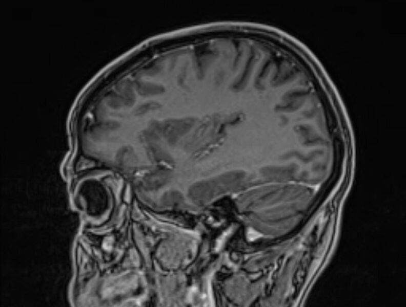 File:Cerebral venous thrombosis (Radiopaedia 71207-81504 Sagittal T1 C+ 47).jpg