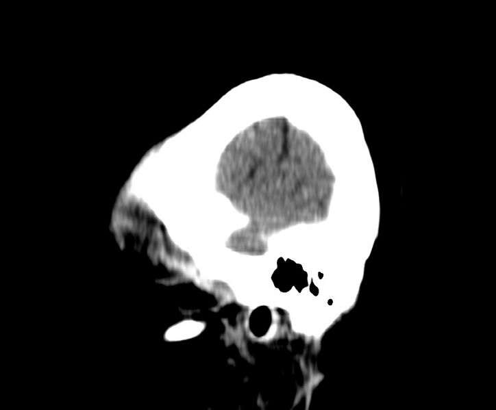 File:Cerebral venous thrombosis - CT only (Radiopaedia 41031-43778 B 45).jpg