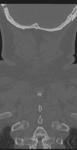 File:Cervical canal stenosis due to ossification of the posterior longitudinal ligament (Radiopaedia 47260-51823 Coronal bone window 61).png