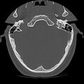 Cervical flexion teardrop fracture with cord hemorrhage (Radiopaedia 32497-33454 Axial bone window 2).jpg