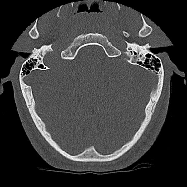 File:Cervical flexion teardrop fracture with cord hemorrhage (Radiopaedia 32497-33454 Axial bone window 2).jpg